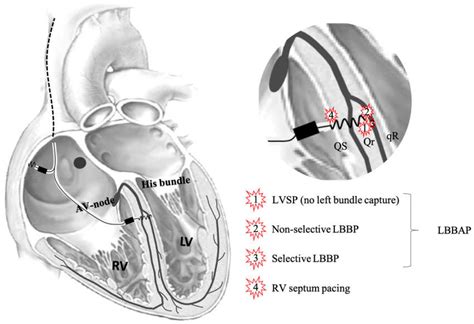 lv pacing on|left bundle branch pacing guidelines.